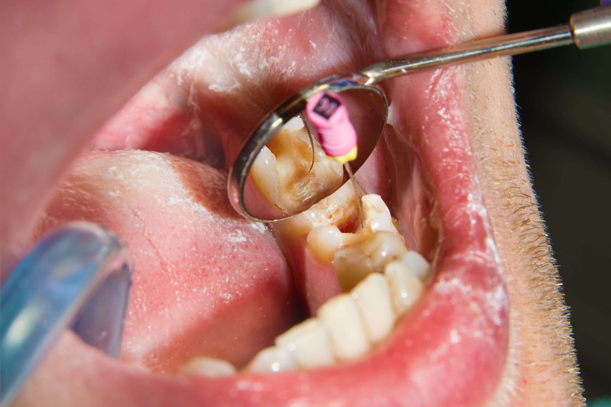 root-canal-therapy-nerang-gold-coast-dental-studio